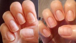 Как восстановить ногти после наращивания гелем и акрилом Сколько восстанавливаются ногти после наращивания